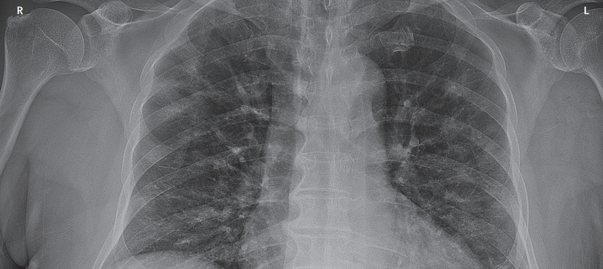Chest x-ray, coronavirus